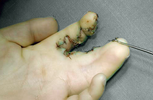 Syndactyly 2nd, 3rd, 4th fingers and early results